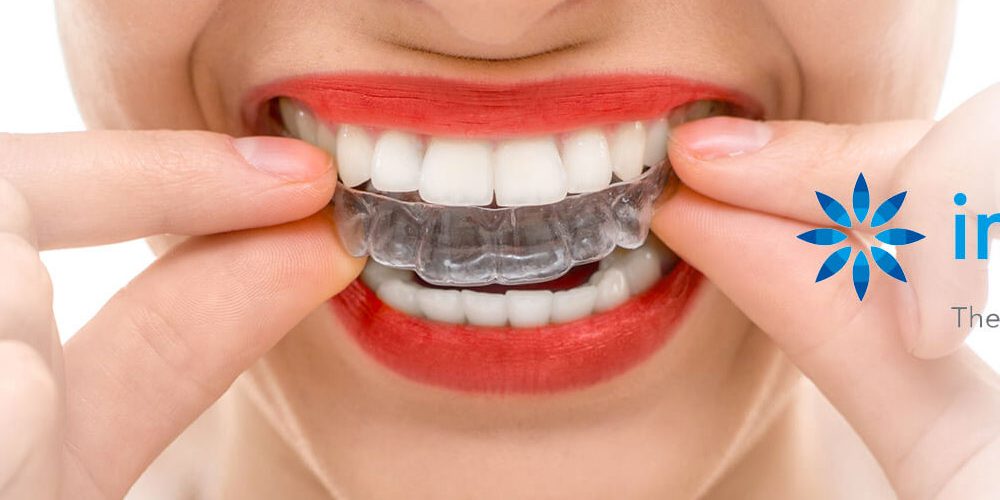 The Ins And Outs Of Invisible Braces (Invisalign / Smile Tru)